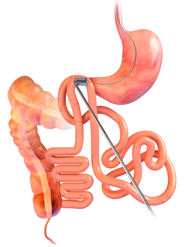 Illustration of two sections of intestine being brought together during the procedure