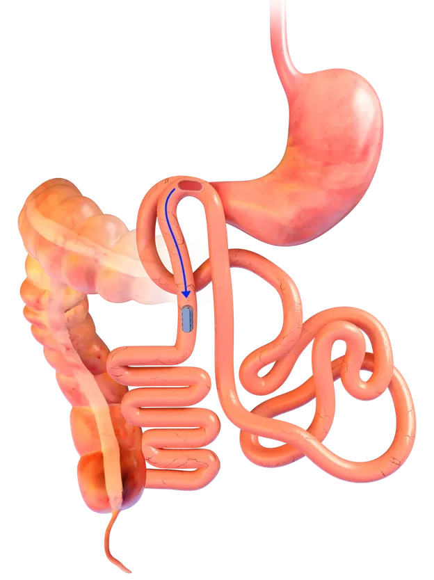 Illustration of the joined magnets passing through the intestine after the connection forms