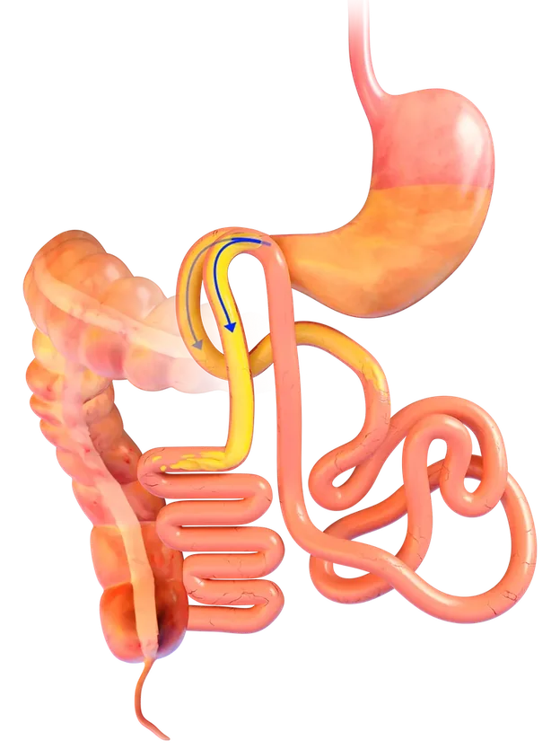 Illustration of some food taking the new shorter route through the intestine